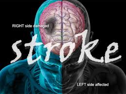 Awas Stroke