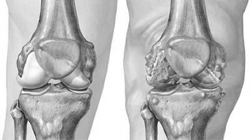 Gout Artritis